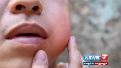 தமிழ்நாட்டில் அதிகரிக்கும்  mumps நோய் 